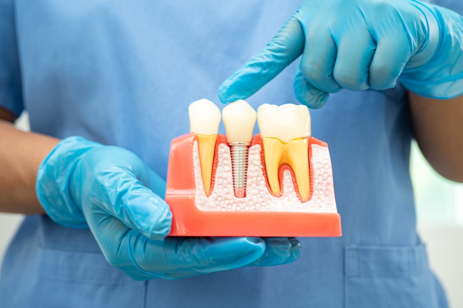 dental implant artificial tooth roots into jaw r 2024 01 23 00 10 24 utc scaled