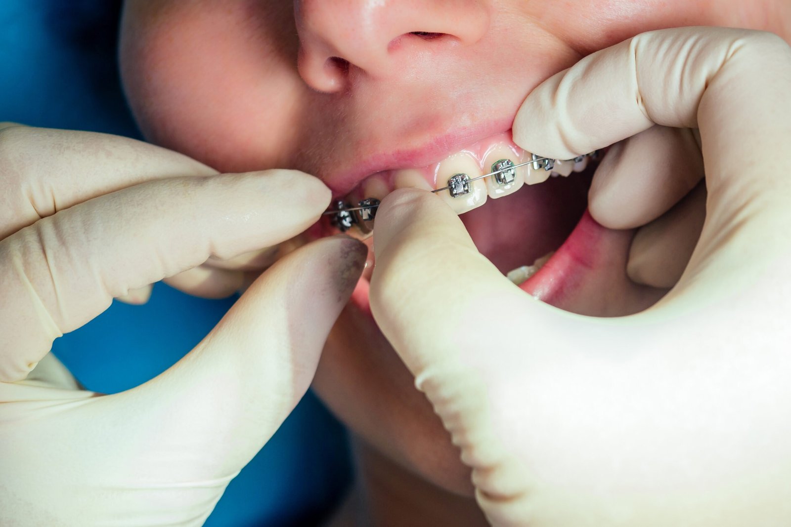 female dental open mouth with fixator gel braces a 2023 11 27 05 22 48 utc scaled
