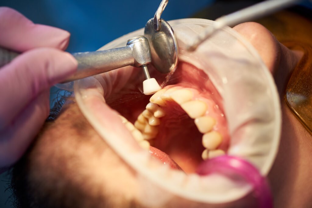 closeup of dental treatment where teeth polished w 2023 11 27 05 19 50 utc