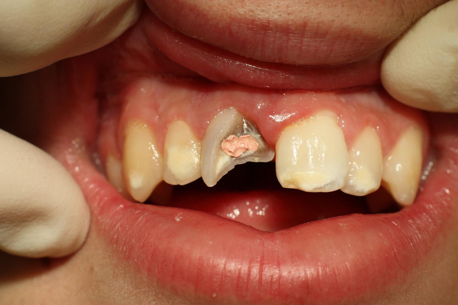 complicated injuries dental trauma alam impian