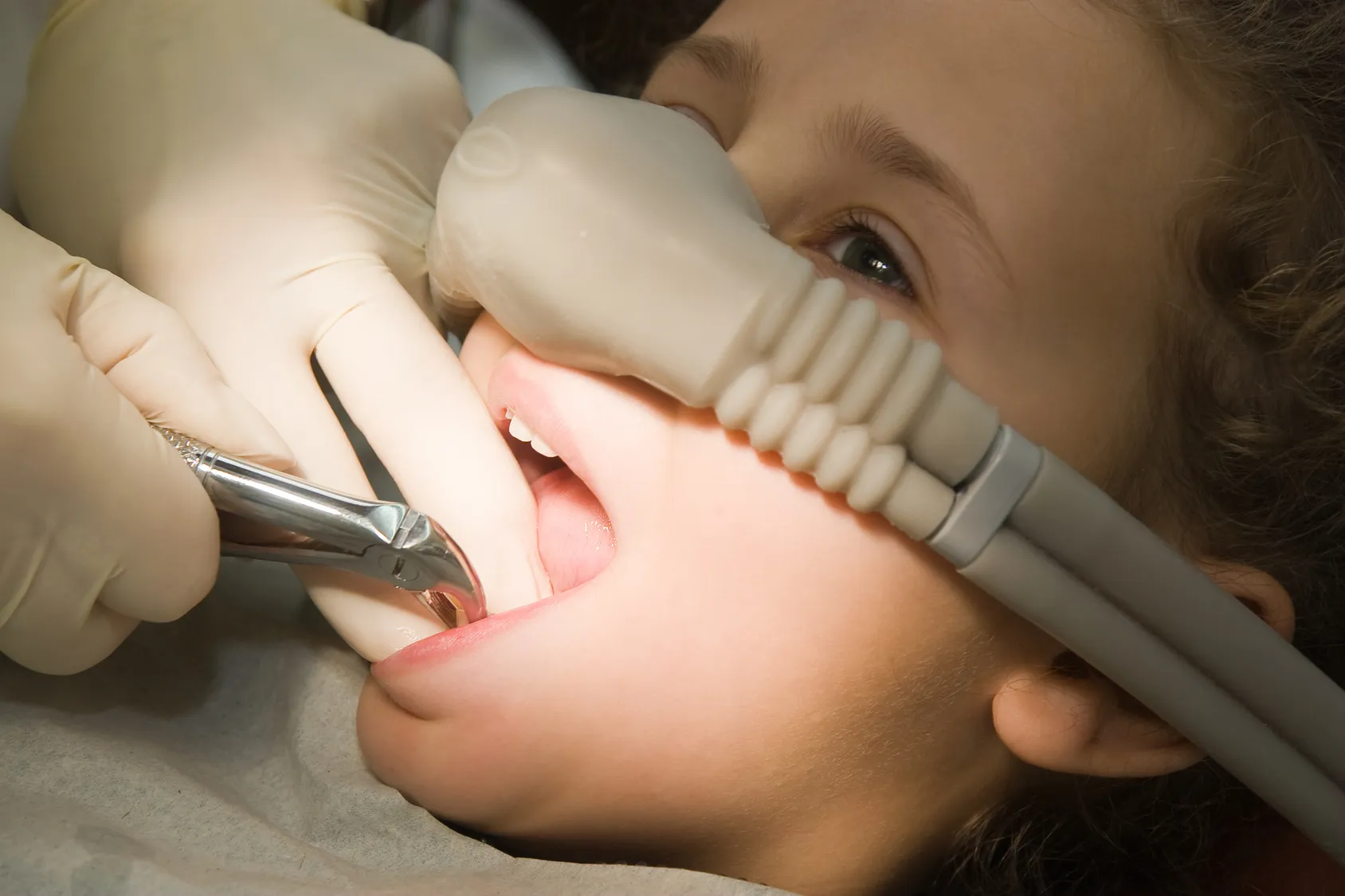 sedation dentistry nitrous oxide gas alam impian
