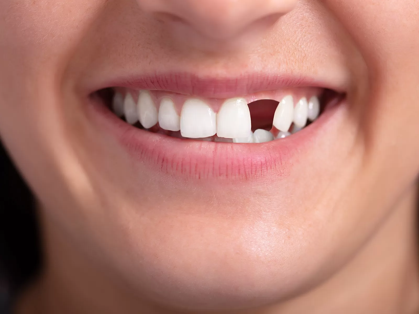 severe injuries dental trauma alam impian 1