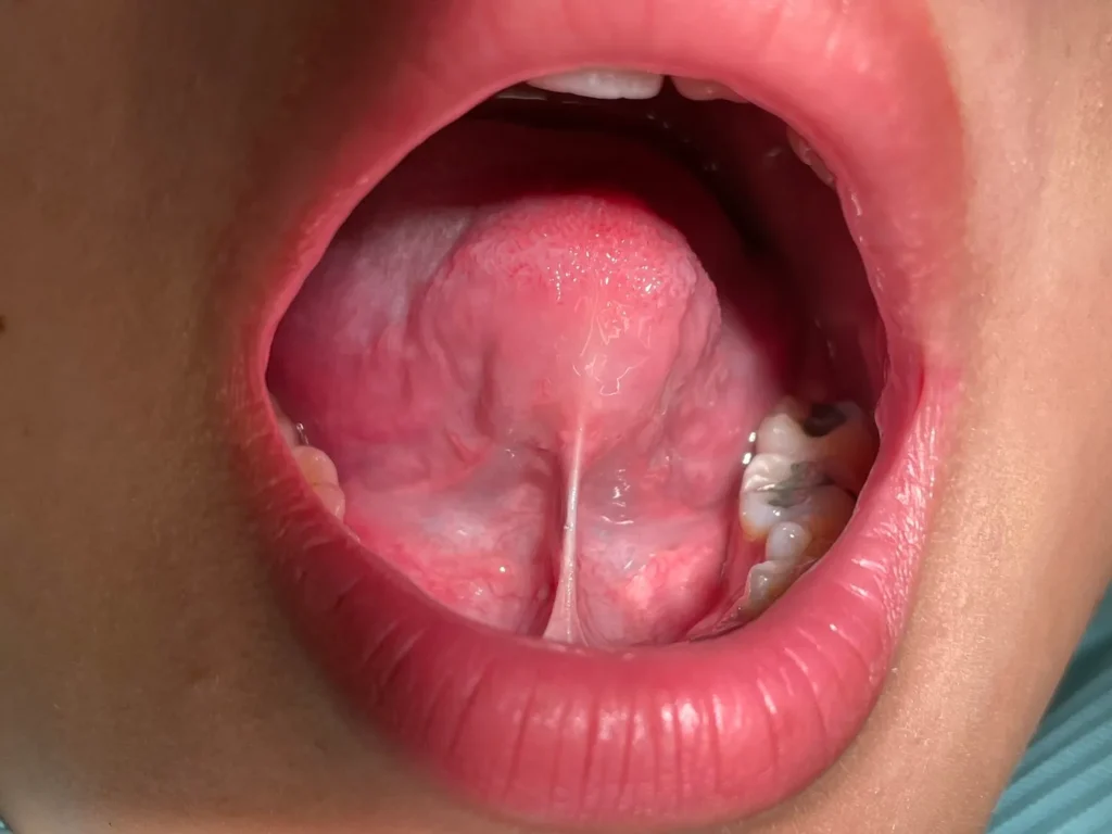 tongue tied baby types of tongue tie alam impian