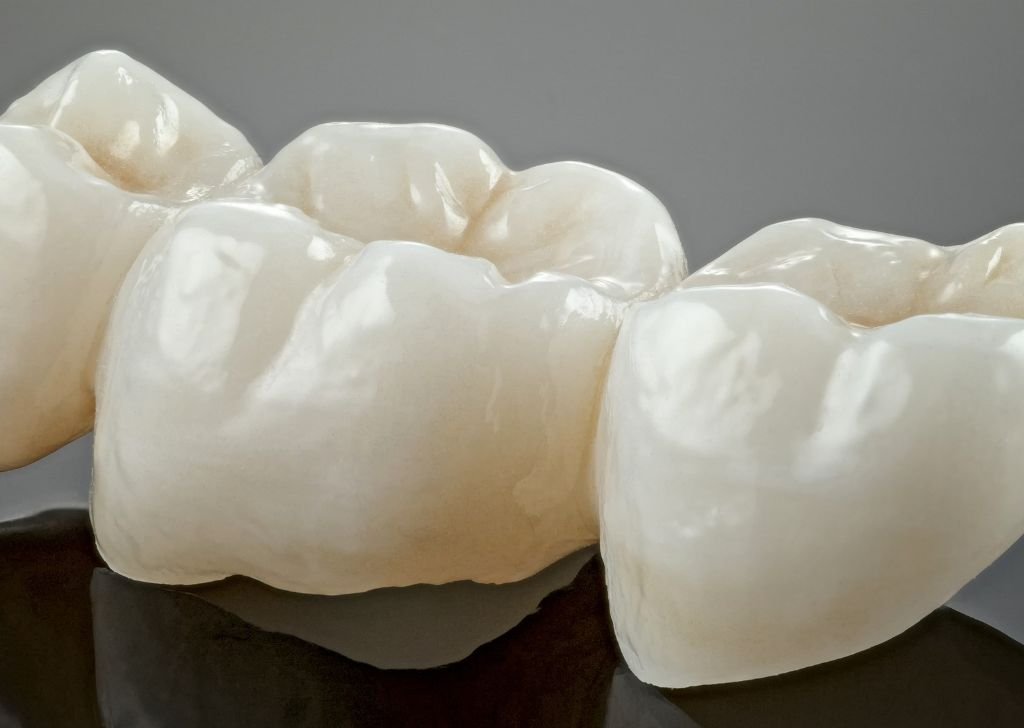 Dental Crown & Bridge in Alam Impian, Shah Alam