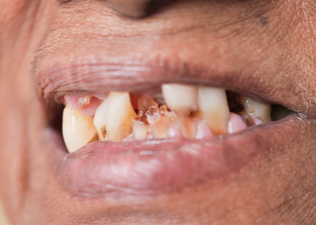 Dental Crown & Bridge in Alam Impian, Shah Alam